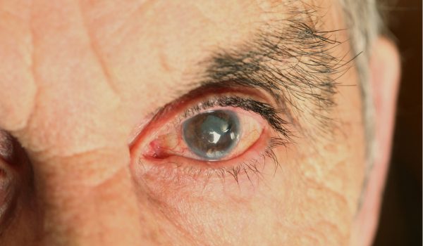 Close-up photo of a senior person’s eye with a cloudy lens from a cataract.