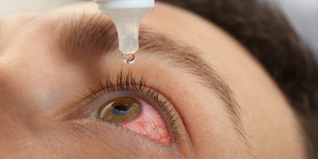A close-up of one eye held open as an eye drop is about to fall into the eye.
