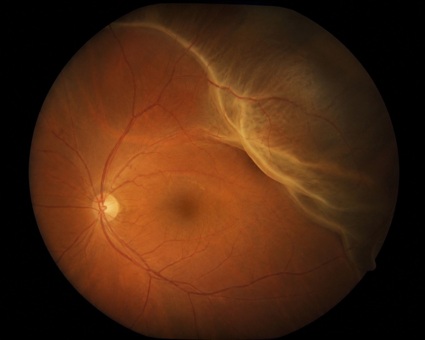 Inside of an eye showing a partial retinal detachment