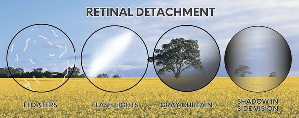 Visual examples of retinal detachment symptoms